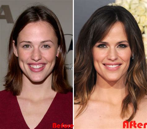 Jennifer Garner Before and After Plastic Surgery